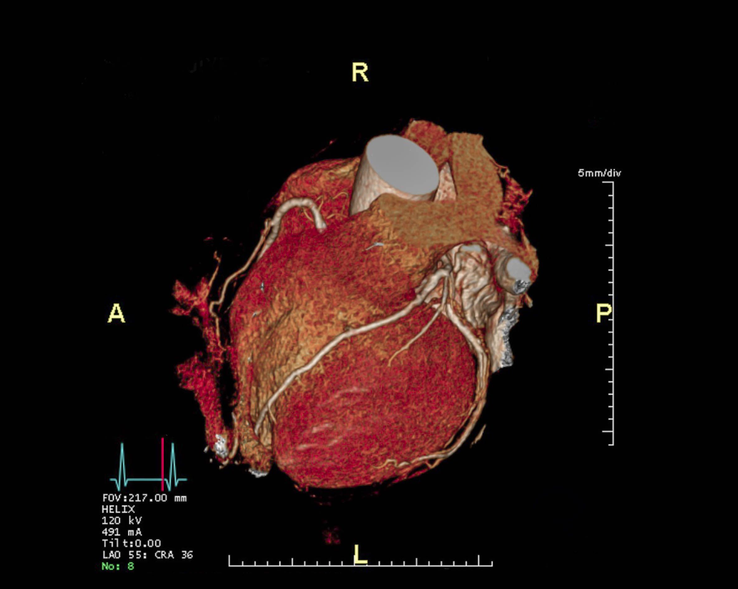 Coronary Artery Calcium Score CT MDLifespan